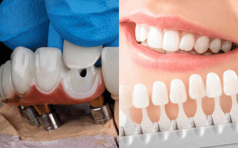 Crowns or Veneers